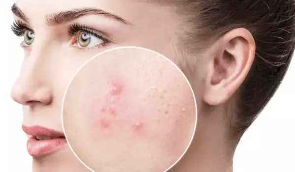 Avocadobladeren helpen bij acne